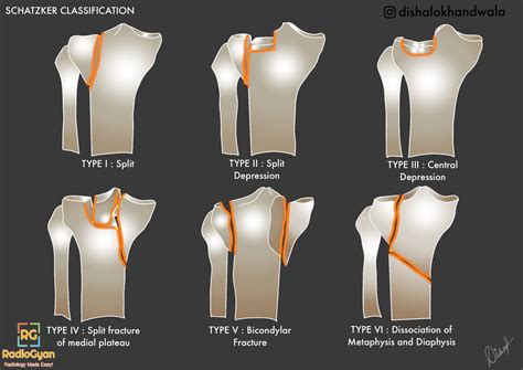 Schatzker Classification of Tibial Plateau Fractures - RadioGyan