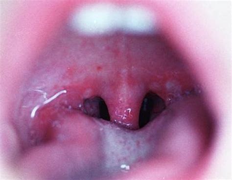 Herpangina Vs Strep Throat