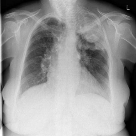 Plombage | Radiology Reference Article | Radiopaedia.org