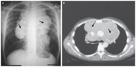 Bilateral Hilar and Mediastinal Lymphadenopathy | NEJM