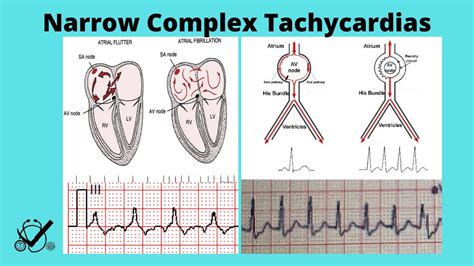 Sinus Tachycardia Vs Atrial Flutter