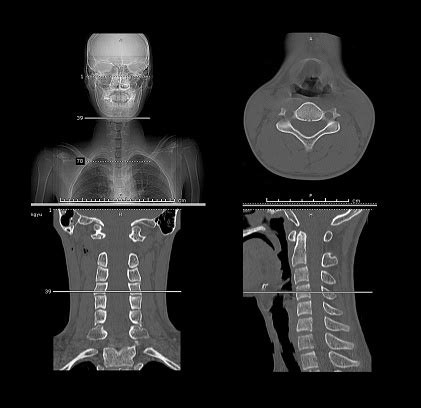 Foto de Imagem De Tomografia Computadorizada De Coluna Cervical Imagem ...