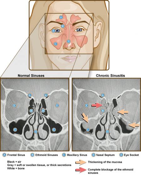 Sinusitis - WikEM