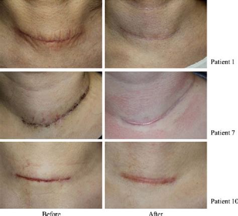 Figure 1 from Appropriate Timing for Thyroidectomy Scar Treatment Using a 1,550‐nm Fractional ...