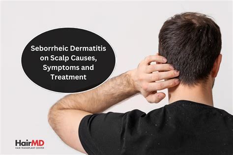 Seborrheic Dermatitis: Causes, Symptoms and Treatment