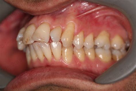 Case 8: Protruded and Irregular Teeth | Teeth N Braces