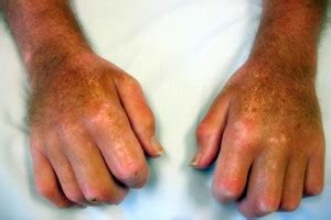 Scleroderma-Polymyositis