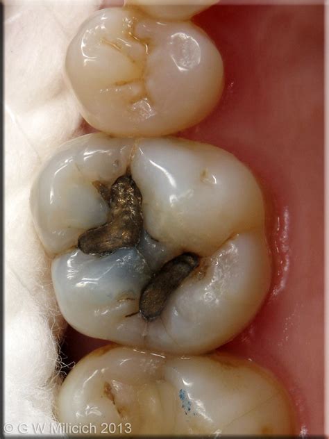 The Six Fracture Modes of Teeth - Graeme Milicich - The British Dental ...