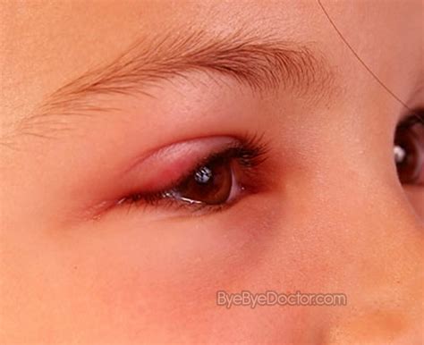 Swollen Eyelid - Treatment, Causes, Pictures, Symptoms, Remedies