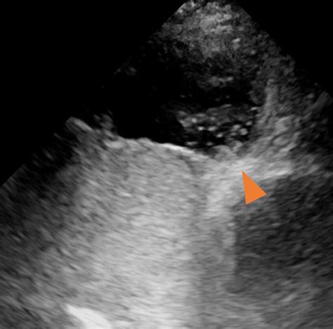 Transesophageal echocardiography. Transesophageal echocardiogram with ...