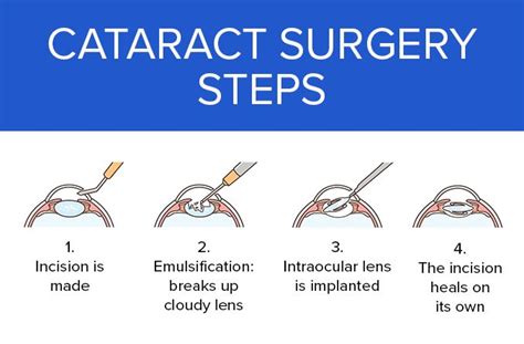 Cataract Surgery: Procedure, Description, Options