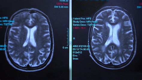 The 'dual stigma' of alcohol-related brain damage - BBC News