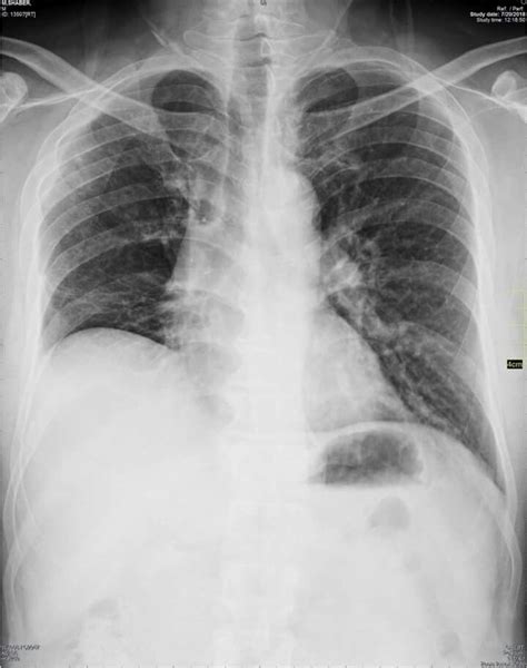 Elevated right hemidiaphragm ?hepatomegaly | Human body anatomy, Radiology, Body anatomy