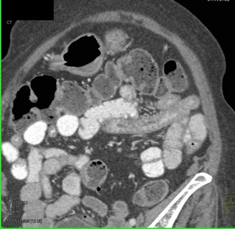 Crohn's Disease with Thick Bowel--- LLQ - Gastrointestinal Case Studies - CTisus CT Scanning