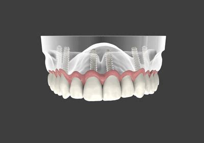 What Are Implant Supported Dentures? - Pacific Horizon Dental Arts Placentia California