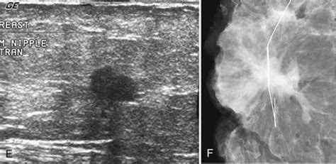 Mammogram Interpretation | Radiology Key