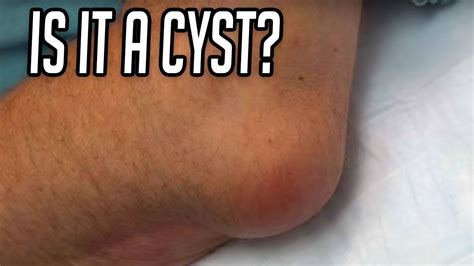 Elbow cyst? Abscess? Lipoma? - YouTube