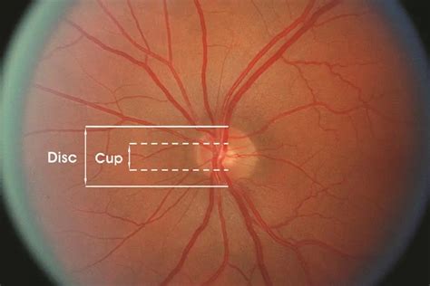 Cup–disc ratio - American Academy of Ophthalmology