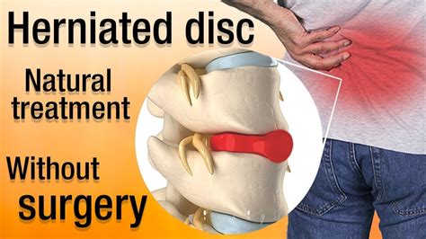 How to heal a herniated disc naturally? Treatment and recovery - YouTube