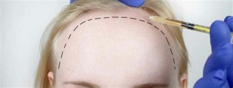 Female Hair Transplant Reviews | Dr. Yetkin Bayer Clinics