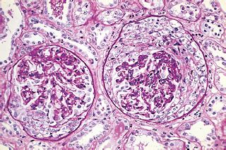 MBBS Medicine (Humanity First): Rapidly Progressive Glomerulonephritis (RPGN).