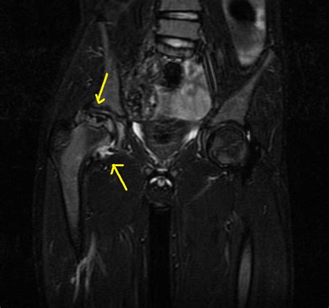 Legg-Calvé-Perthes disease-MRI - Sumer's Radiology Blog