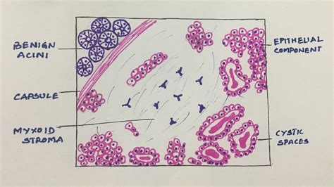 pleomorphic adenoma – Histopathology.guru