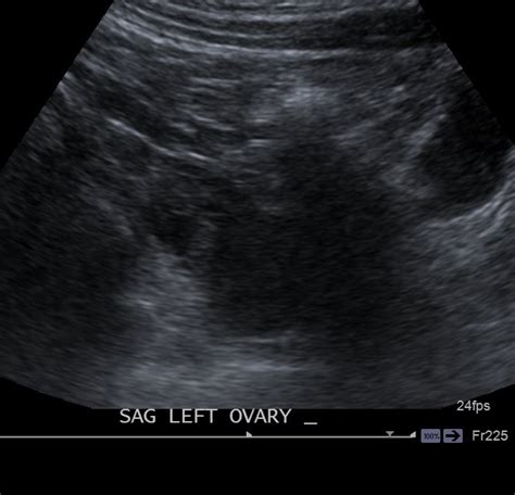 Testicular Ultrasound Preparation