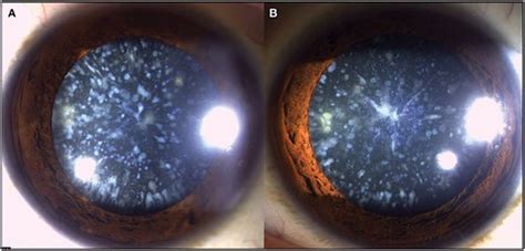 Cerulean Cataract - Ophthalmology Education - educate.choroida.com