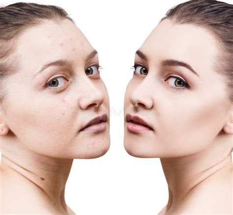 Girl with Acne before and after Treatment Stock Image - Image of acne ...