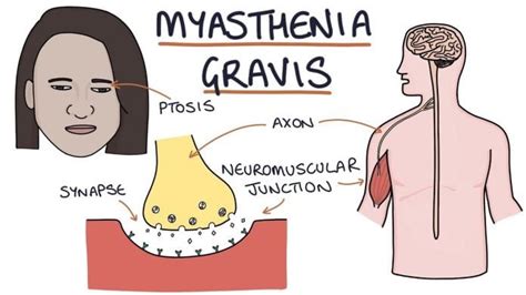 Myasthenia Gravis - 03 Symptoms, Causes & Complications