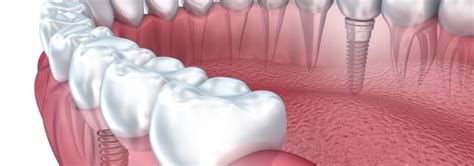 Why Basal Implants are better than Conventional Implants?