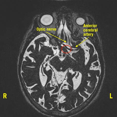 Normal Optic Nerve