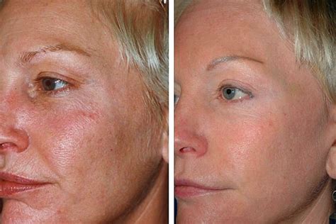 Laser Skin Resurfacing Can Reduce Wrinkles Instead Of Facelift