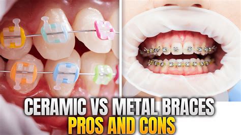 Metal vs Plastic vs Ceramic Brackets