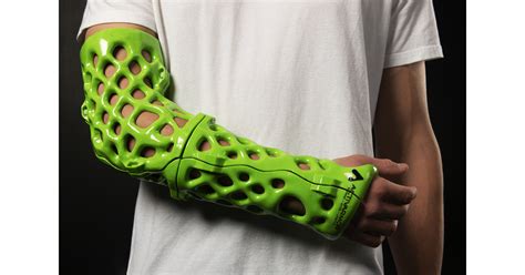 New 3D-Printed Orthopedic Casts