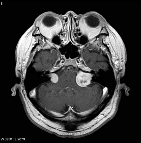 Neurofibromatosis Type 2 - Oncology - Medbullets Step 2/3