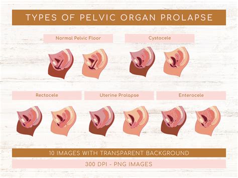 Types of Pelvic Organ Prolapse Rectocele Stages Cystocele Stages Uterine Prolapse Stages ...