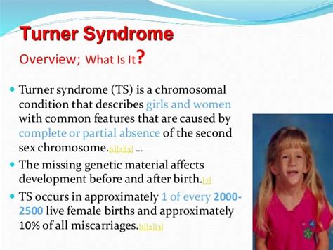 Turner syndrome