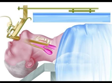 Zenker's Diverticulum Surgery - Endoscopic Staple Diverticulostomy - YouTube