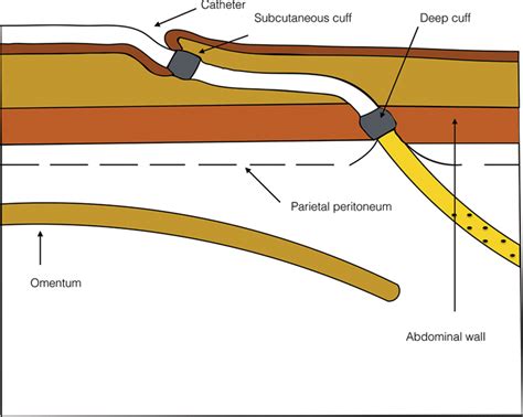 Pd Catheter Not Draining Well - Best Drain Photos Primagem.Org