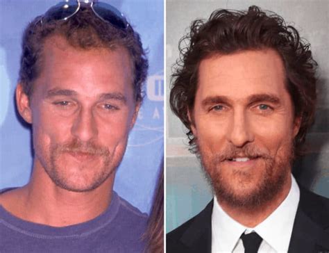 14 Celebrity Hair Transplants You Must See - Bald & Beards