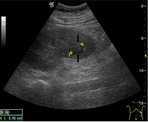 FULL TEXT - Proper diagnosis and treatment of renal abscess: A case report - International ...