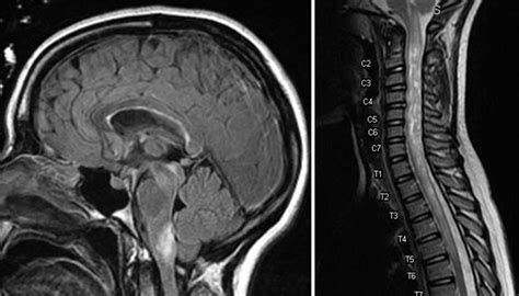 Neuromyelitis Optica (NMO) and Spectrum Disorders | Multiple Sclerosis Center