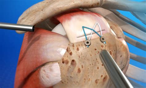 Rotator Cuff Repair - Arthroscopic Surgery