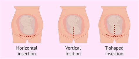 Cesarean section: how is it performed and what care is needed?