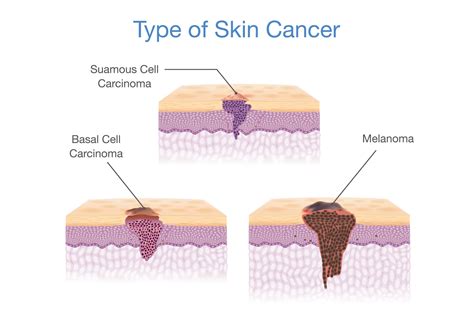 Skin Cancer Types Pics