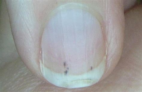 Splinter hemorrhages: Causes and treatment