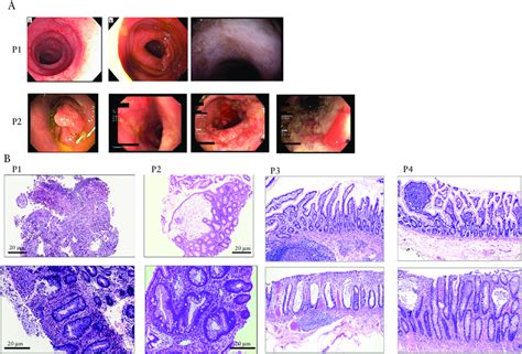 Abnormal colonoscopy and histology of biopsies from ileum and colon of ...