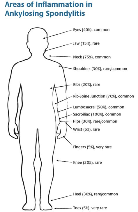 Ankylosing Spondylitis - Causes, Symptoms, Exercises, Treatment